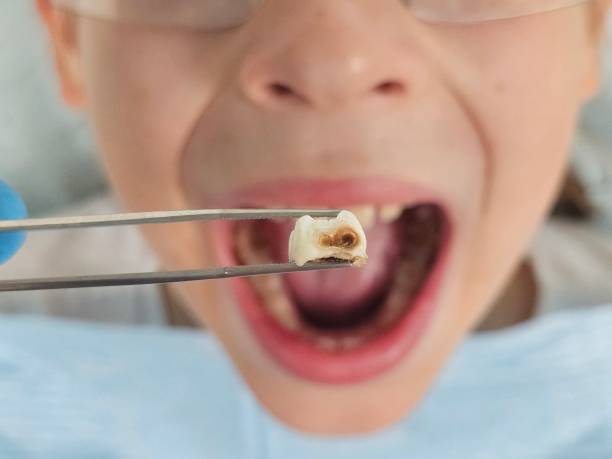 Best Emergency Treatment for Dental Infections or Abscesses in Herrin, IL